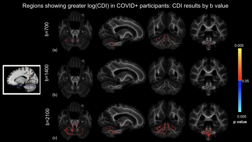 Vergleich der CDI von Covid-positiven und Covid-negativen Gruppen unter...