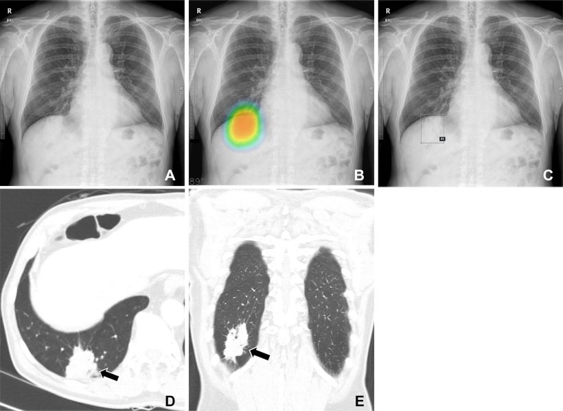 (A–C) Chest radiographs obtained as part of a health checkup in a 71-year-old...