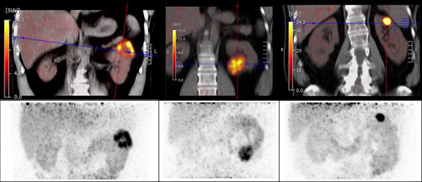 Renal cell carcinoma: New radiotracer improves detection and differentiation