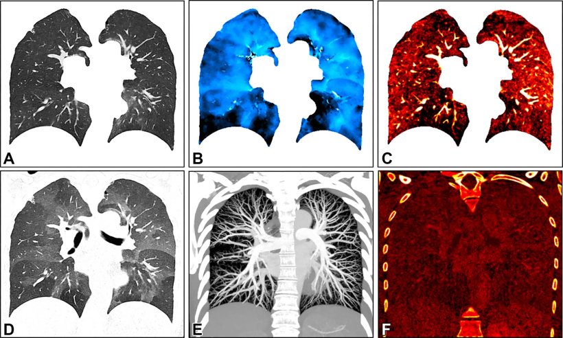 Images in a 34-year-old female patient show severe smoking-associated small...