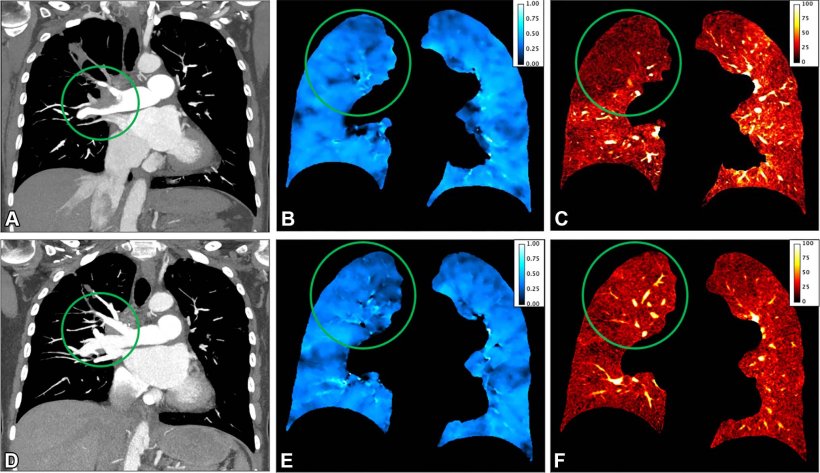 Representative coronal preoperative ventilation-perfusion CT (A–C) and...