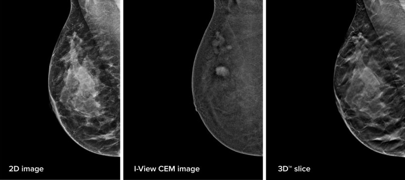 The next breast screening advancement: Contrast-enhanced mammography