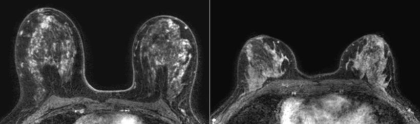 Representative transverse dynamic contrast-enhanced MRI scans in patients in...