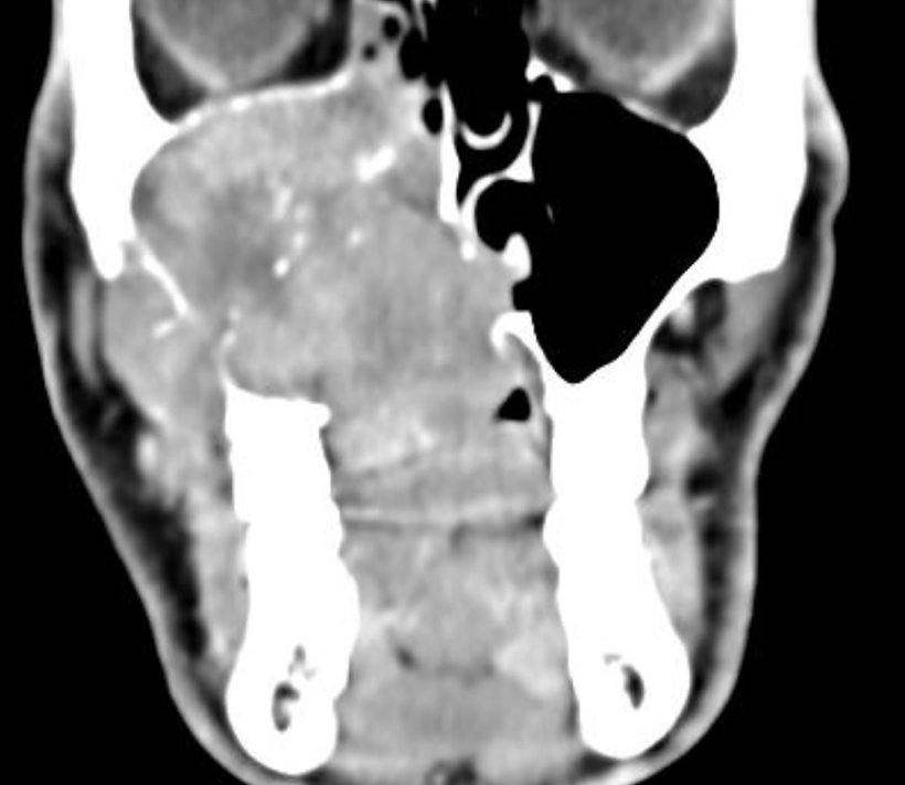 CT-scan in a coronal section showing an adenoid cystic carcinoma as an...