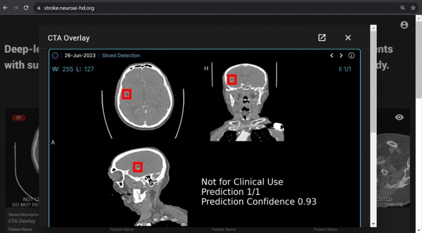 Neue KI-Anwendung im Einsatz: Das Analyseprogramm prüft anhand von CT-Bildern,...