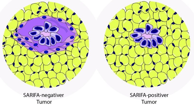 Bei SARIFA-negativen Tumoren (links) werden die Krebszellen (blau) durch...