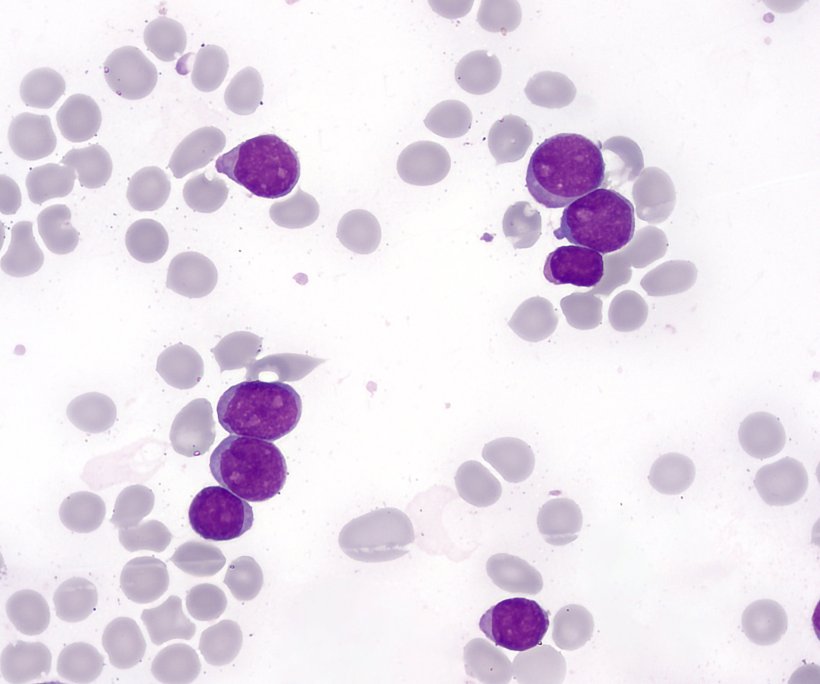 Minimally differentiated acute myeloid leukemia (AML-M0)