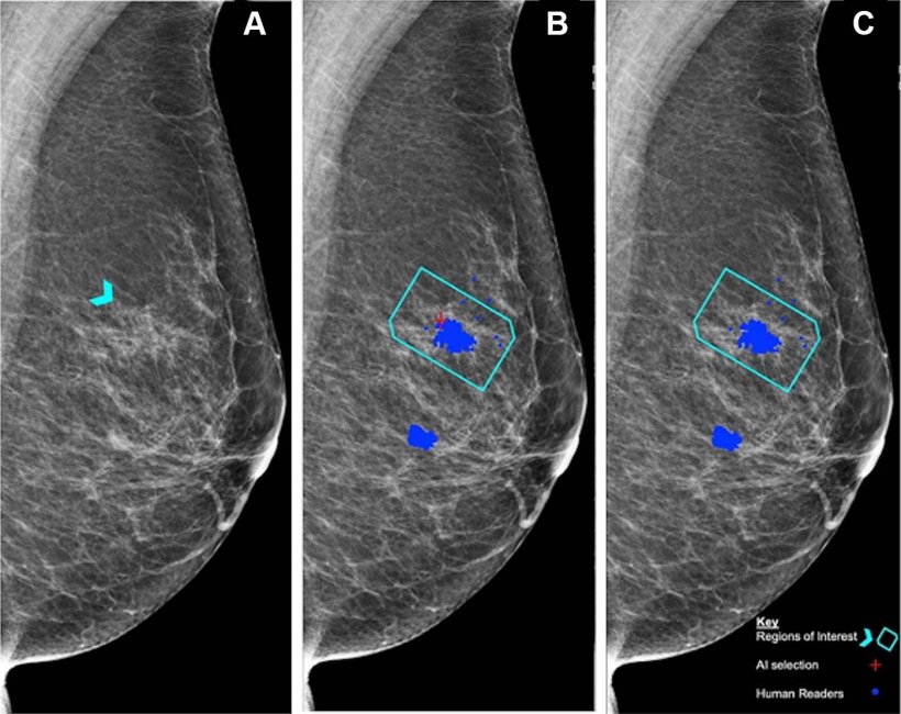 A: Left mediolateral oblique mammogram. Unadulterated mammogram shows an...