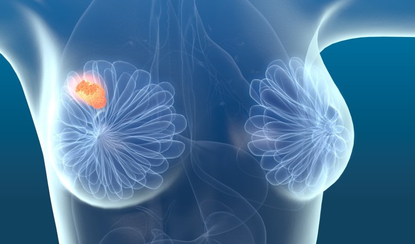 3d illustration of breast cancer in translucent woman model