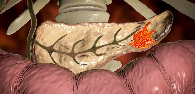 3d illustration of pancreas cancer