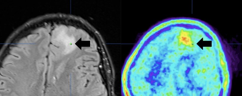 On the left, an image of the brain obtained using magnetic resonance imaging;...