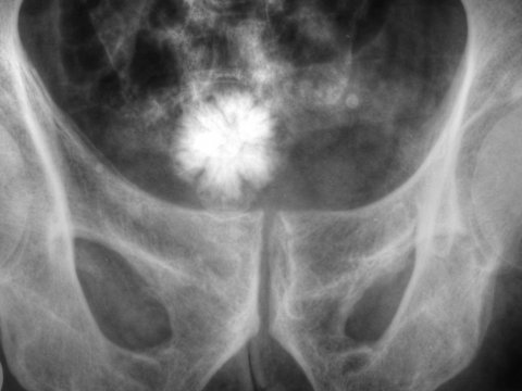 xray image of bladder stone