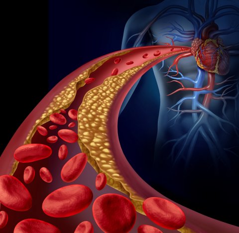 Clogged artery and atherosclerosis disease medical concept with a three dimensional human artery with blood cells that is blocked by plaque buildup of cholesterol as a symbol of vascular diseases