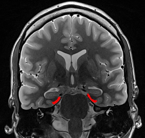 mri image of the human brain, the entorhinal cortex highlighted in red