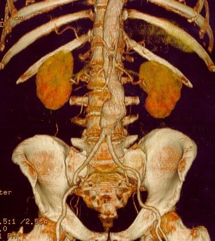 ct scan of aortic aneurysm in the abdomen