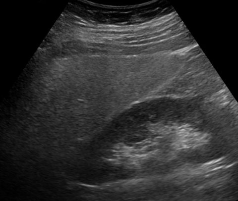 ultrasound scan of fatty liver