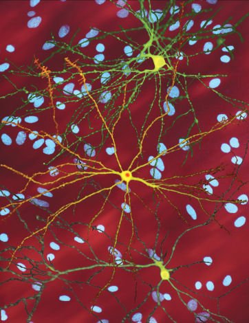 single striatal neurons (yellow) transfected with nuclear inclusion (orange) mHtt, other neurons in background (blue)