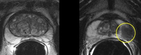 prostate cancer radiology