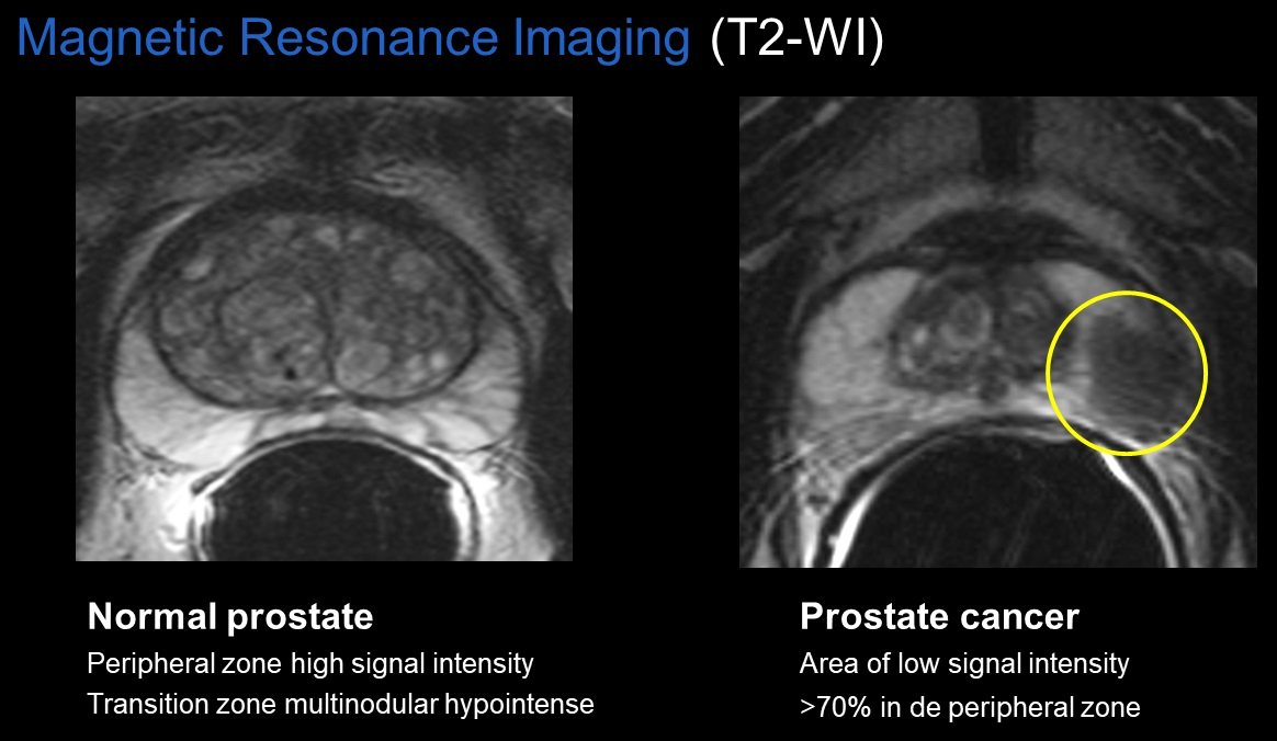 normal prostate mri radiopaedia