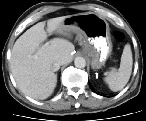 ct scan of stomach with crohn's disease
