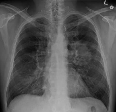 lung cancer on x-ray image