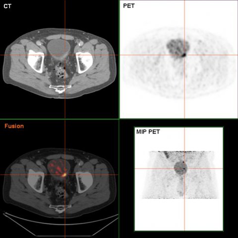 pet image of bladder tumour