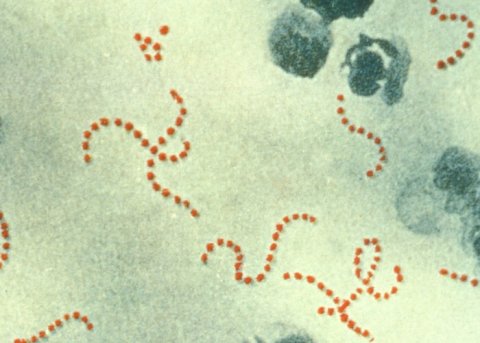 photomicrograph of a pus specimen, viewed using Pappenheim's stain, revealing numbers of chain linked Streptococcus pyogenes bacteria