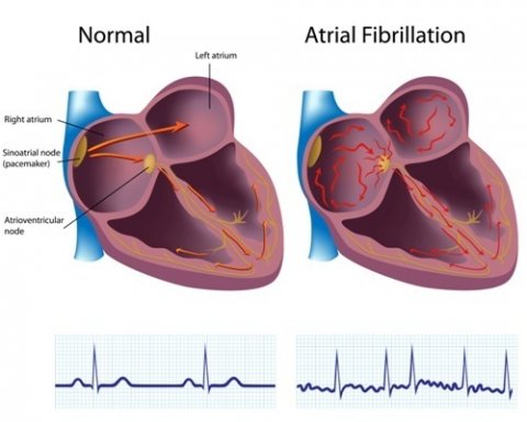 normal heart rhythm and atrial fibrillation comparison