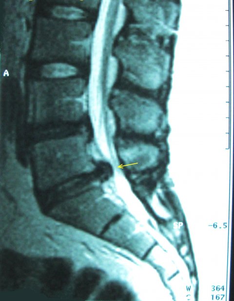 MRI of Spinal disc herniation