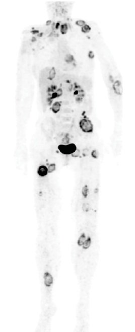 Multiple CUP manifestations in PET/CT imaging