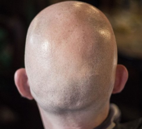 back of a bald man's head