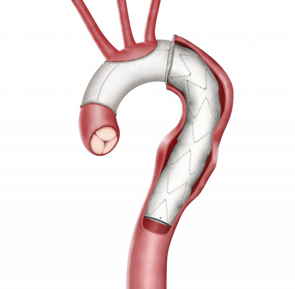 New lease of life thanks to new aorta • healthcare-in-europe.com