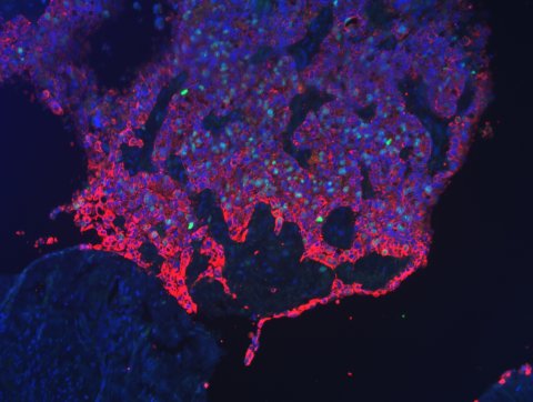 Fluoreszenzbild einer Tumorfront des Gebärmutterhals.
