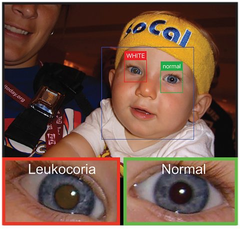 app-based detection of pediatric eye disease