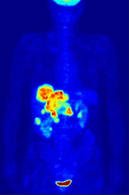 PET-MIPS image of colon cancer metastases