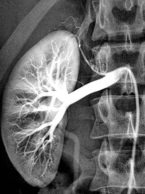 contrast agent enhanced xray image of human kidney