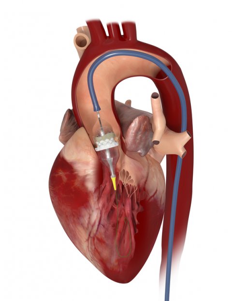 New Ways To Treat Severe Aortic Stenosis • Healthcare In