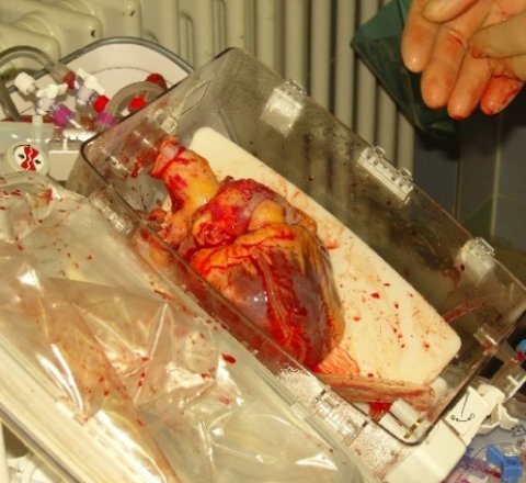 ocs organ care system for human heart