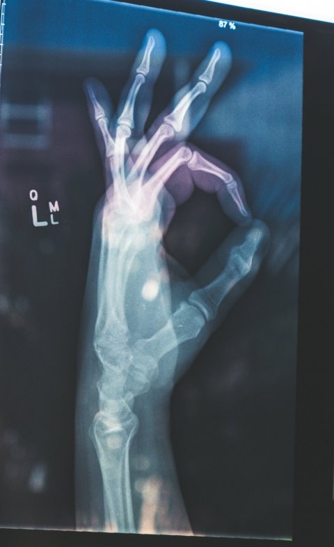 xray of hand gesturing an ok sign