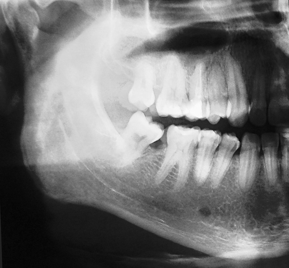 double exposure dental radiography
