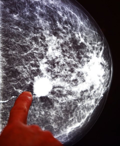 X-ray mammogram image of breast with cancer