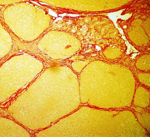 fibrosis in rat liver tissue