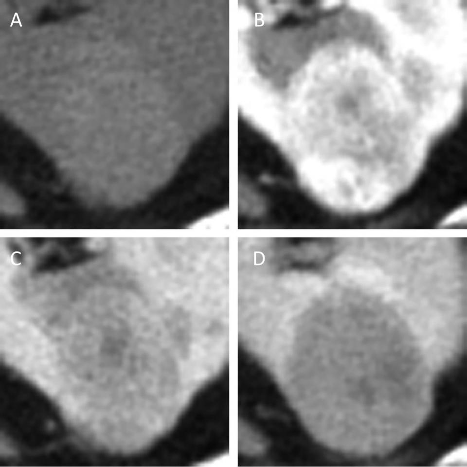 algorithm-differentiates-small-renal-masses-on-multiphase-ct