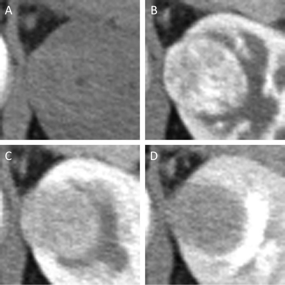 algorithm-differentiates-small-renal-masses-on-multiphase-ct