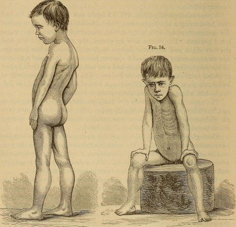 illustration of medical effects of duchenne muscular dystrophy in a boy