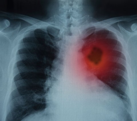 xray image of human lungs with tumor marked in red