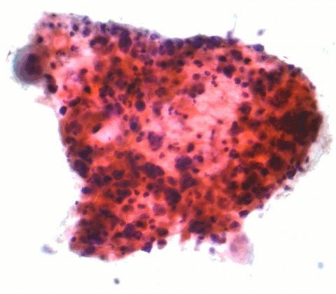 Micrograph of squamous carcinoma. FNA specimen of a lung lesion