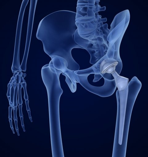 illustration of hip bone implant