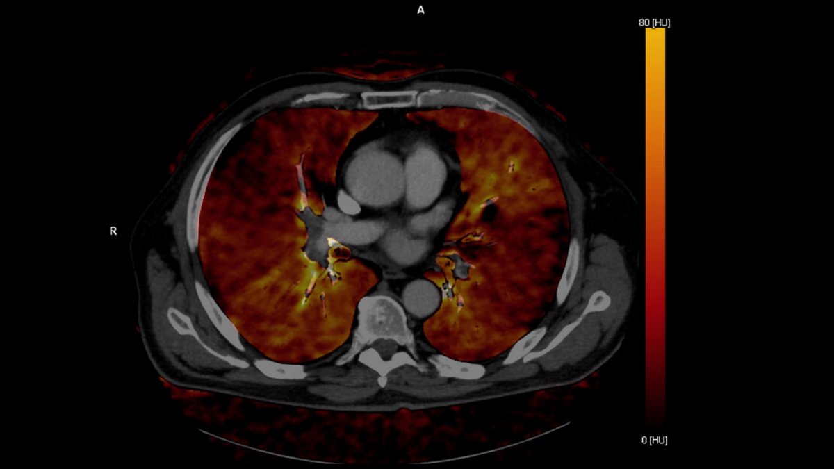 Twinbeam Dual Energy Spectral CT of the lung. 