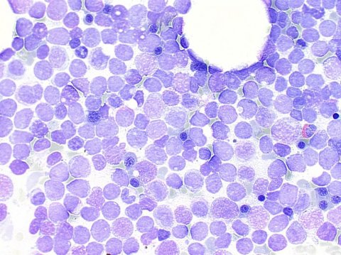 aml leukemia blood platelets
